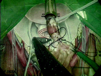 Fig 2 Use of the robotic instrument during the urethrovesical anastomosis - photo 2