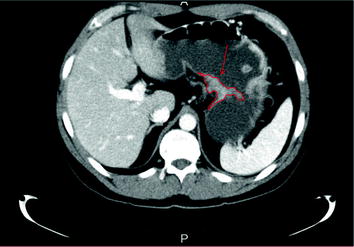 Fig 2 MDCT showing gastric carcinoma indicated by red part prior operation of - photo 2