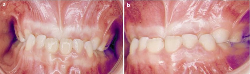 Fig 11 a b Frontal and lateral pretreatment photographs A significant - photo 1