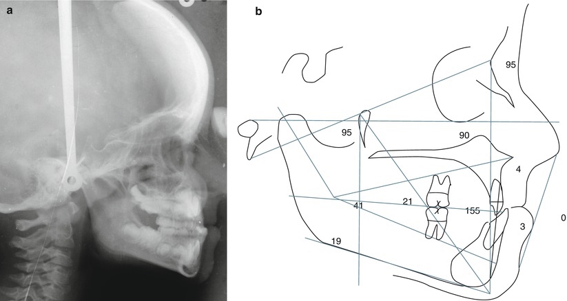 Fig 12 a b Pretreatment lateral radiograph and Ricketts analysis The - photo 2