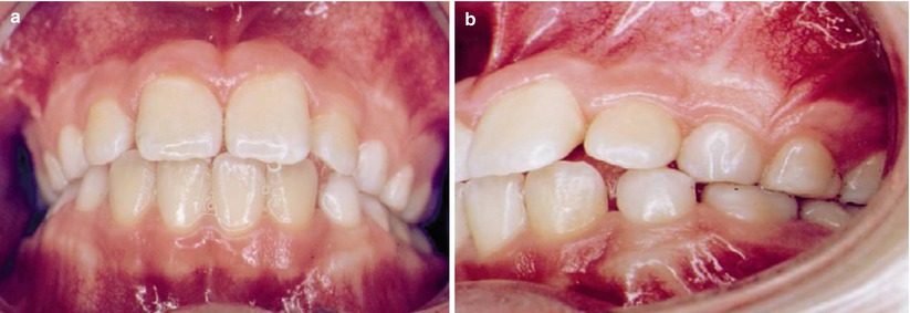 Fig 13 a b Frontal and lateral posttreatment photographs at the end of - photo 3