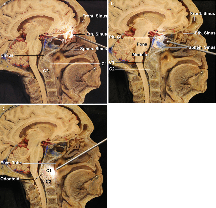 Fig 12 Specimen divided in the midsagittal plane to show the endoscopic - photo 3