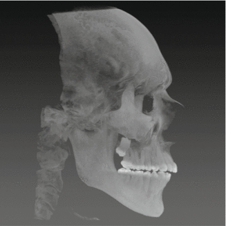 Fig 14 CBCT profile scout view to ensure that the wax-bite wafer is - photo 4