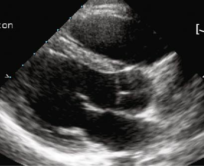 Figure 11 Parasternal 2D long axis view showing anterior extending from the - photo 1