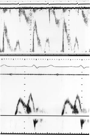 Figure 12 Transmitral Doppler flow velocities from a young subject showing - photo 2