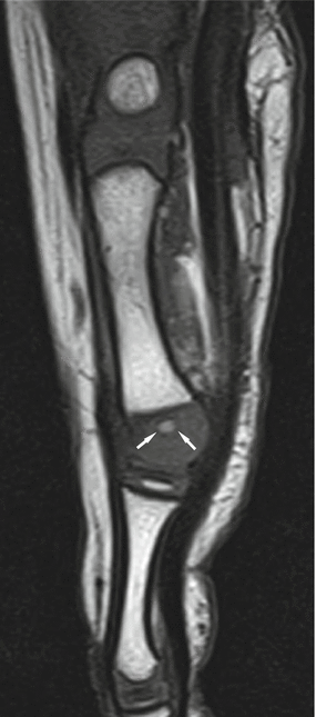 Fig 110 A 3-year-old boy Sagittal T1-weighted image of the foot shows a - photo 10