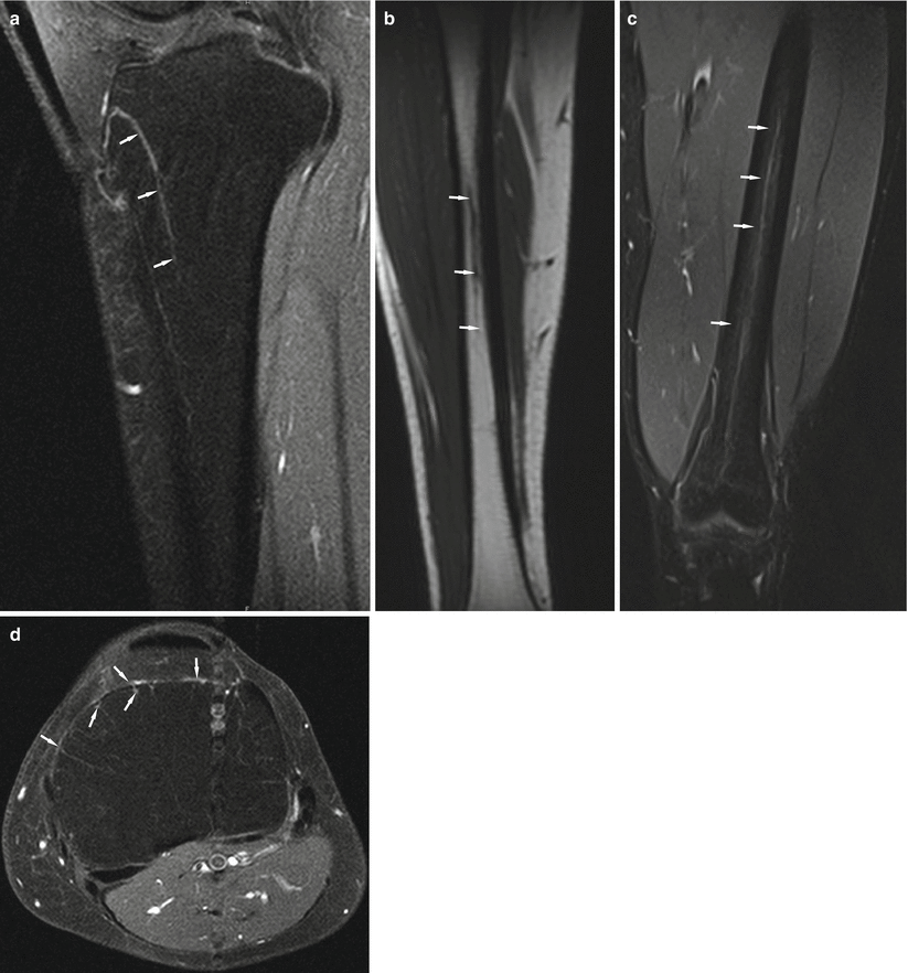 Fig 11 Sagittal proton density-weighted image of the proximal tibia a - photo 1