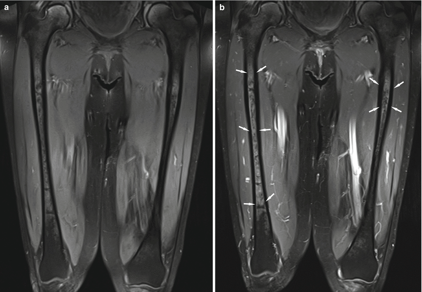 Fig 12 Coronal precontrast T1-weighted fat-suppressed image of bilateral - photo 2