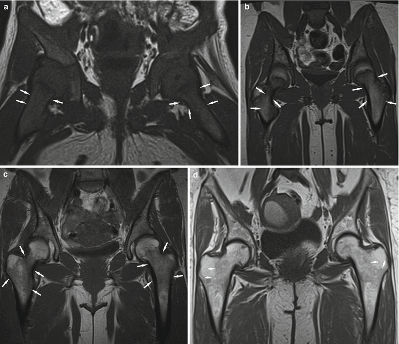 Fig 13 Coronal T1-weighted images of the pelvis in different ages A - photo 3