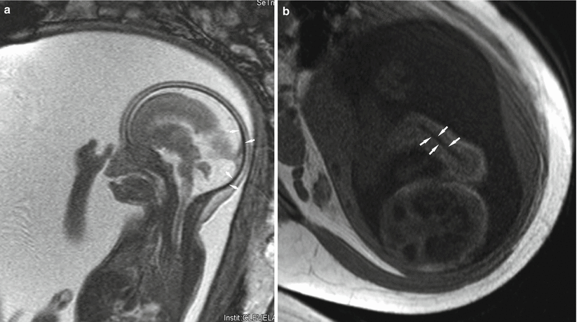 Fig 14 MRI in a 20-week-old fetus Images obtained using TrueFISP technique - photo 4