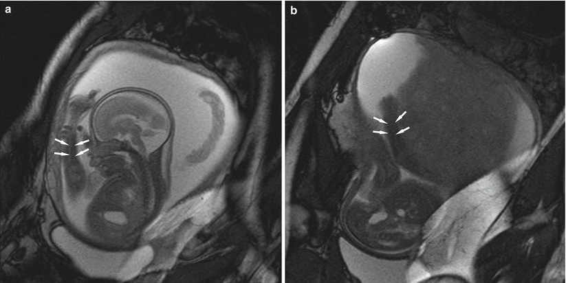 Fig 15 MRI in a 25-week-old fetus Images obtained using TrueFISP technique - photo 5