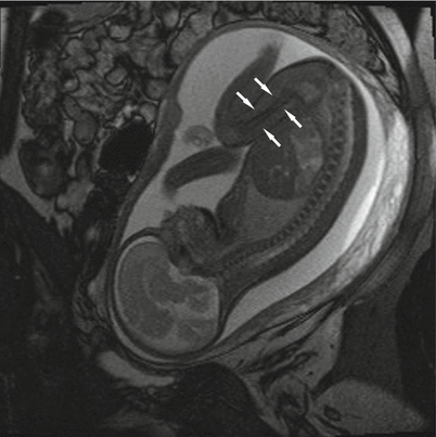 Fig 16 MRI in a 28-week 2-day-old fetus Images obtained using TrueFISP - photo 6