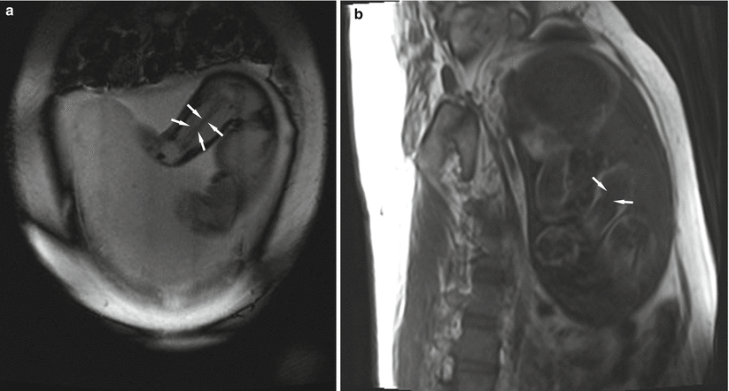 Fig 17 MRI in a 33-week 2-day-old fetus Humeral bone marrow signal arrows - photo 7