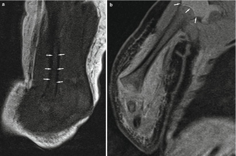 Fig 18 MRI in a 2-day-old neonate Prominent red marrow signal is noted in - photo 8