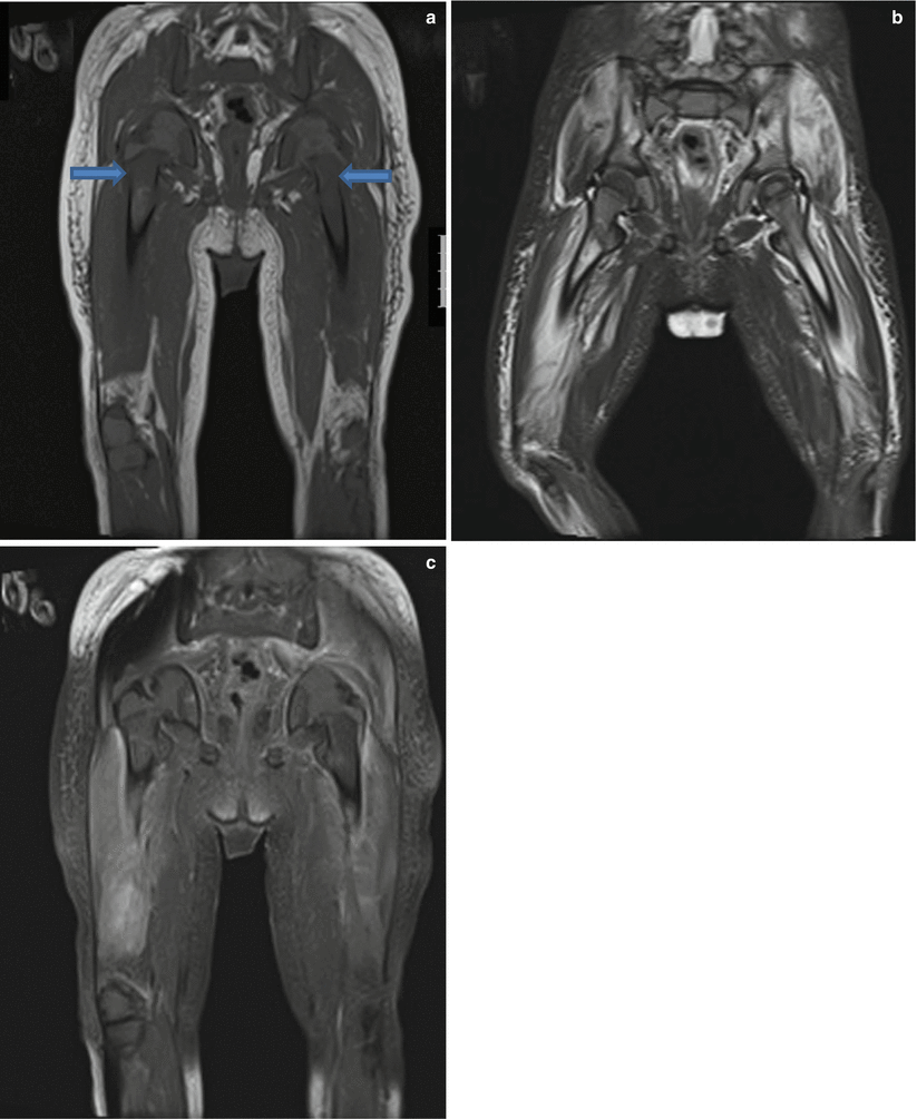 Fig 19 A 2-year-old boy presented with difficulty in walking MRI of the - photo 9