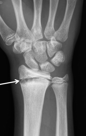 Fig 1 The PA radiograph of the right wrist in a 14-year-old female gymnast - photo 1