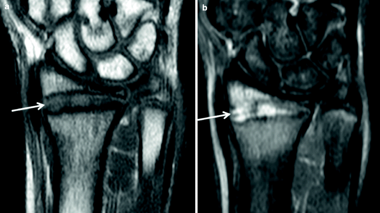 Fig 2 Coronal T1-w a and STIR b MR images from the same patient as - photo 2