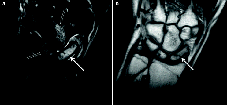 Fig 3 The coronal STIR a and T1-w b MR images in a 16-year-old female - photo 3