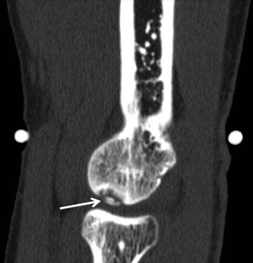 Fig 4 Sagittal CT MPR image showing an osteochondral lesion with a loose bone - photo 4