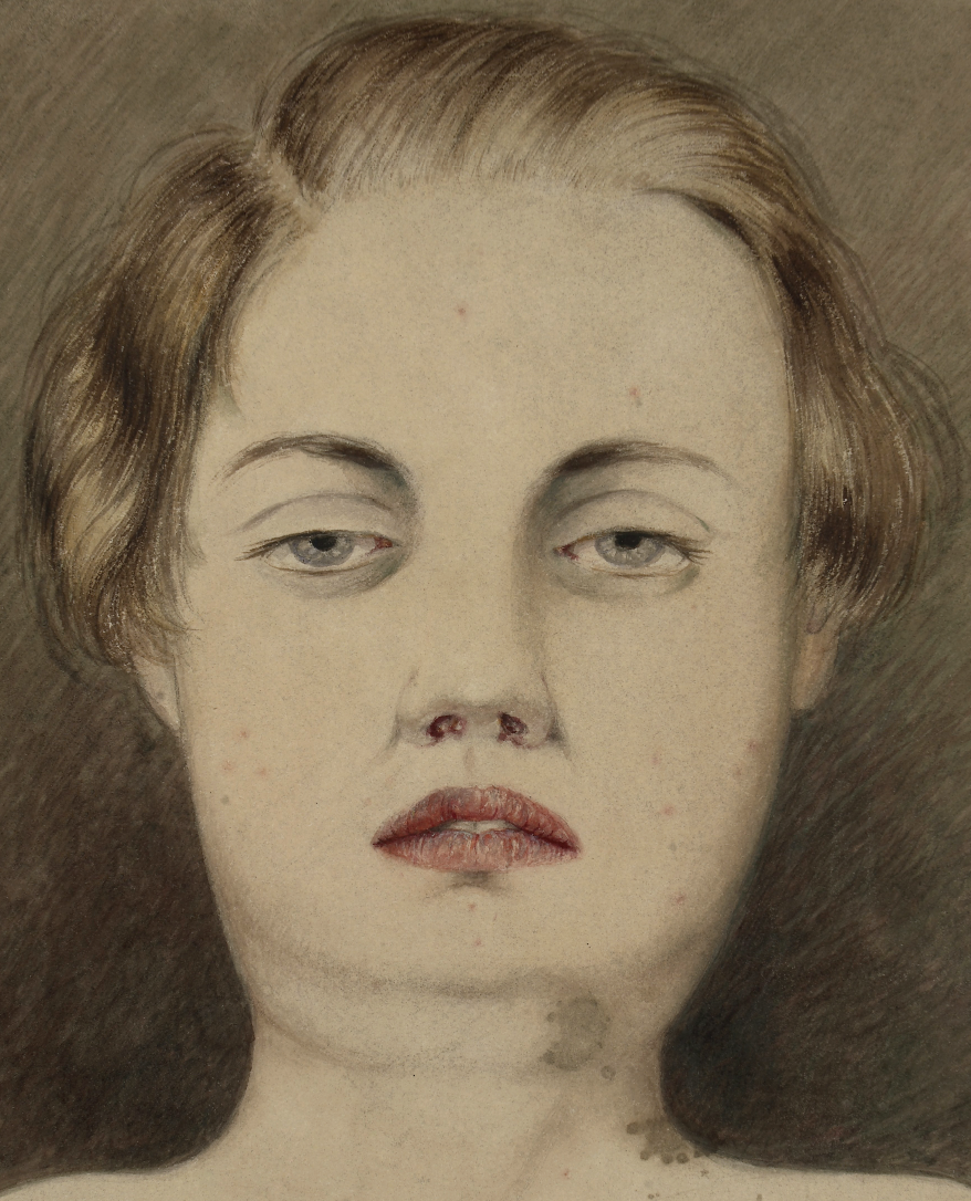 An 1882 painting of a typhoid patient shows her bloody nose and spots on her - photo 3