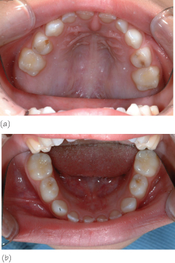 Bitewing radiographs showing extent of caries Intra-oral view showing - photo 2