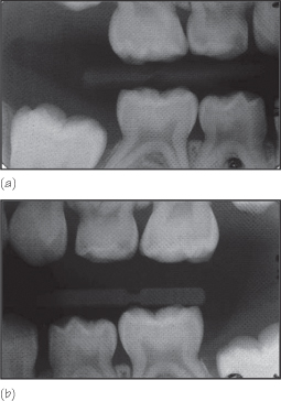 Intra-oral view showing upper a and lower b arches at the end of treatment - photo 3