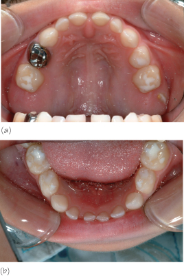 Postoperative radiographs of the treated case Follow-up visit revealed - photo 4