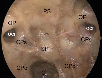 Fig 11 Anatomical picture showing the posterior wall of the sphenoid sinus - photo 1