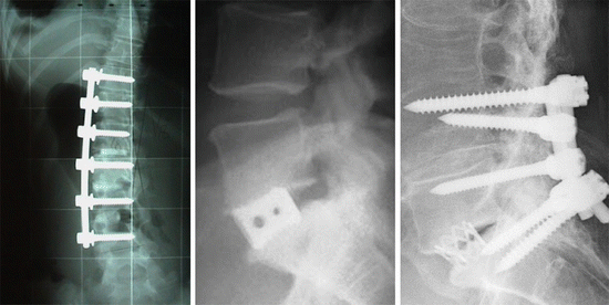 Fig 11 Orthopaedic implants used in spinal surgery In each case significant - photo 1