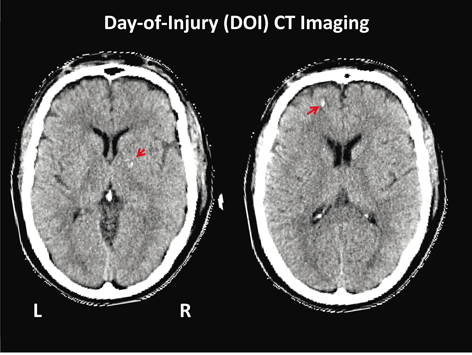 Fig 11 Axial day-of-injury CT scan showing the location of two of several - photo 1