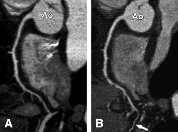 Fig 21 Comparison of 16-row Panel A and 64-row CT coronary angiography - photo 1