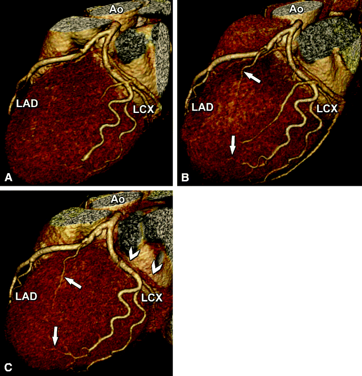 Fig 23 Example illustrating the improved depiction of distal coronary artery - photo 3