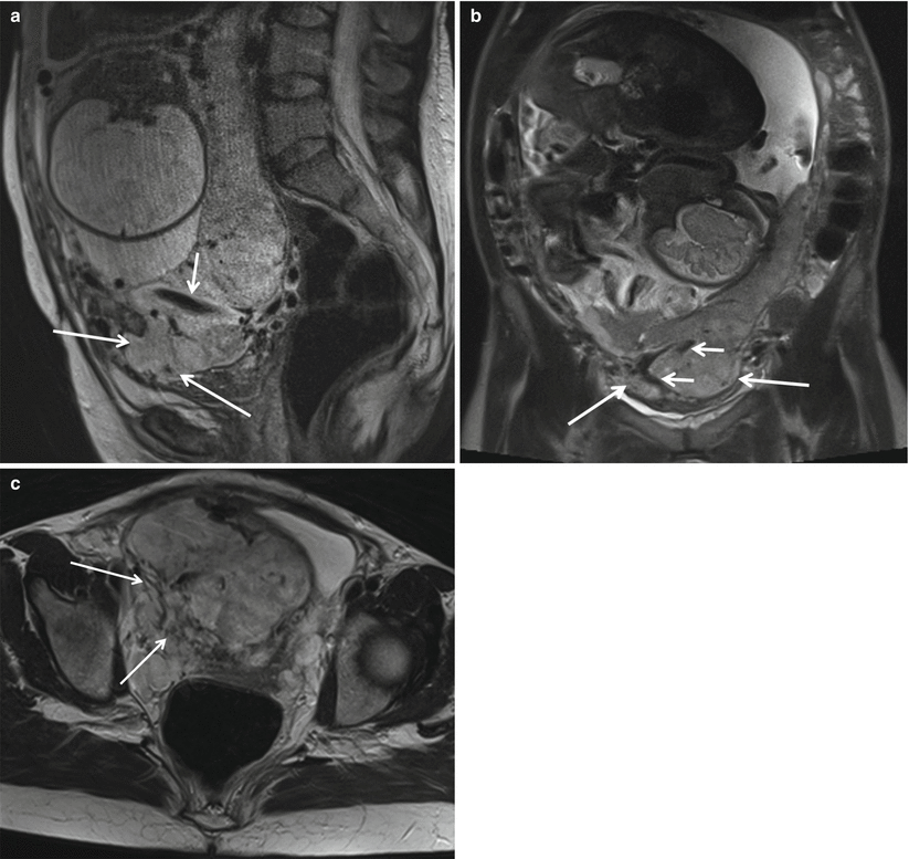 Fig 11 Placenta percreta in a 28-year-old pregnant woman at 34 weeks - photo 1