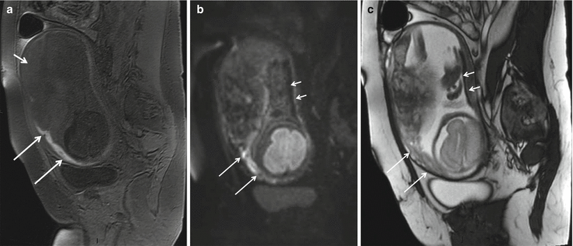 Fig 12 Placental abruption in a 35-year-old woman at 32 weeks of gestational - photo 2