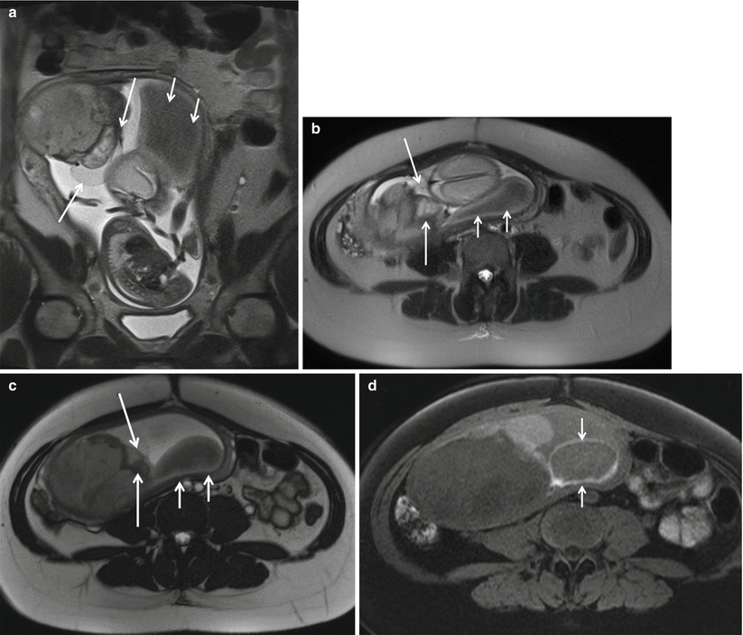 Fig 13 Placental chorioangioma in patient at 24 weeks of gestational age and - photo 3