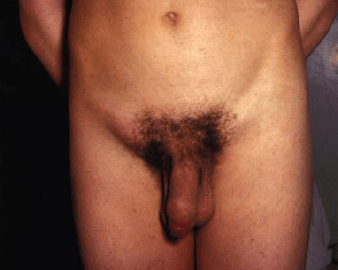 Figure 11 Bilateral inguinal lymph node enlargement in primary syphilis - photo 1