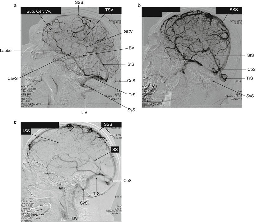 Fig 11 The cerebral veins Panel a lateral view of the main cerebral - photo 1