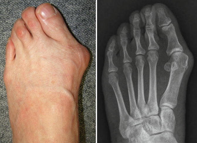 Fig 11 Hallux valgus characterized by lateral deviation of the great toe and - photo 1