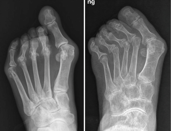 Fig 12 Two variant patterns of hallux valgus deformity of rheumatoid - photo 2