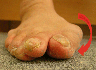 Fig 13 The hallux pronation deformity in the moderate hallux valgus - photo 3