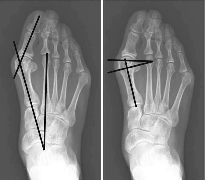 Fig 15 Hallux valgus angle HVA first-second intermetatarsal angle IMA - photo 5