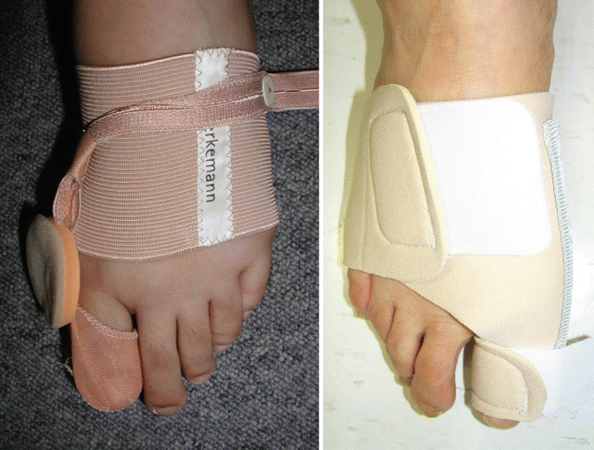 Fig 16 Night brace for hallux valgus Indications of conservative care are - photo 6