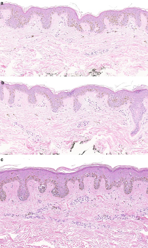 Fig 12 Lentigo simplex The lesion shows elongation of rete ridges and - photo 2