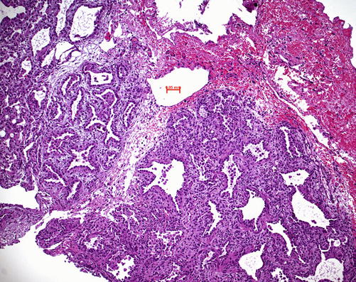 Fig 13 Lung specimen in a premature child gestation week 24 in transition - photo 3