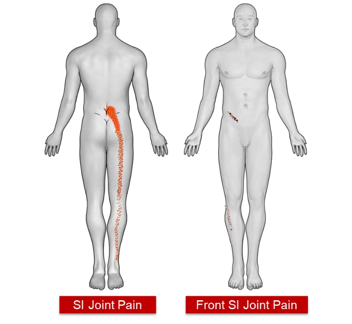Sacroiliac joint dysfunction happens when pain injury or inflammation occurs - photo 1
