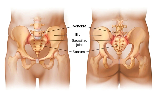 Sacroiliac joint pain is typically discomfort that is centrally located in the - photo 3