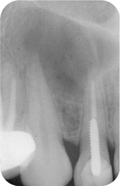 Fig 1-2a Apical periodontitis an important and common disease in western - photo 4