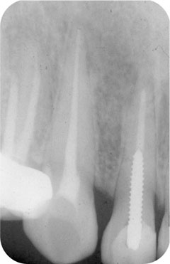 Fig 1-2b Control of aetiological factors allows apical periodontitis to heal - photo 5