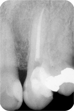 Fig 1-3 Early root canal treatment of a tooth with a dying pulp relieves pain - photo 6