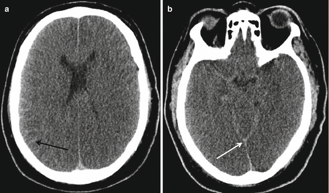 Fig 11 Global edema Axial NECT shows diffuse global hypodensity of the brain - photo 1